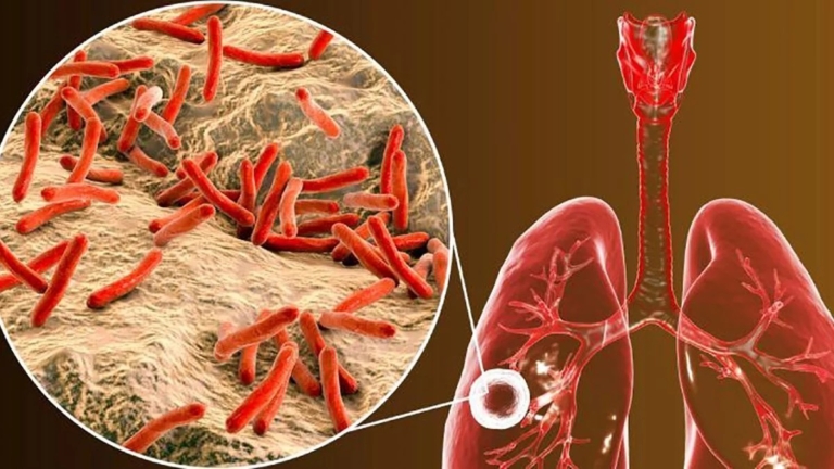 Mueren cuatro personas por brote de tuberculosis en Puerto Rico