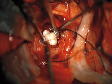 Hallan dientes en el cerebro de un bebé debido a un tumor poco frecuente