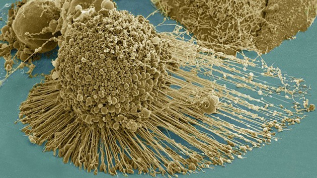 Avance contra el cáncer: una molécula hace que las células cancerosas ‘exploten’