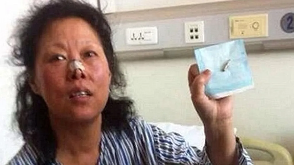 Mujer vive 48 años con bala en el cráneo y sin saberlo