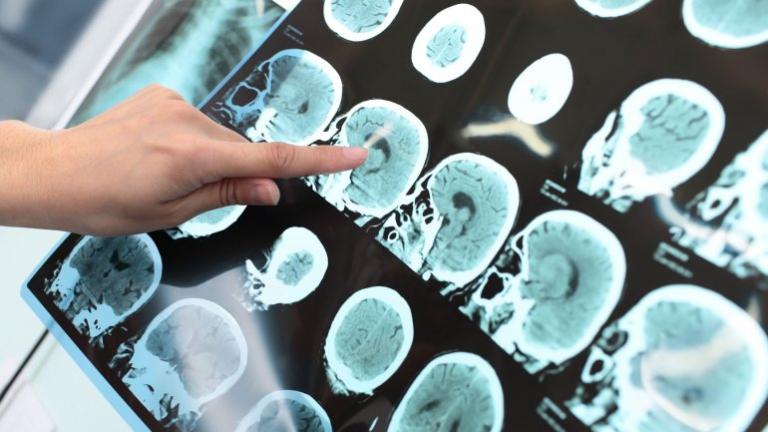 Científicos descubrieron que un fármaco para el cáncer ayuda a prevenir el Alzheimer