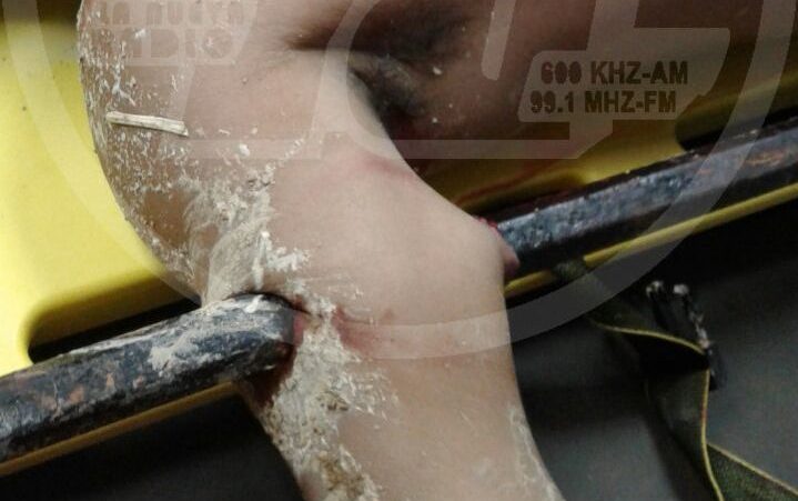 Barra metálica atraviesa el brazo de un obrero en El Rama - La Nueva Radio YA