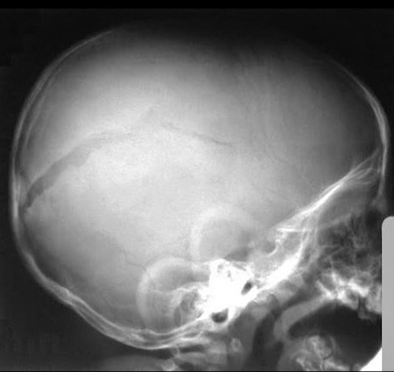 Трещина черепа у ребенка. Перелом костей свода черепа рентген. Перелом теменной кости рентген. Оскольчатый перелом черепа рентген. Оскольчатый перелом свода черепа.