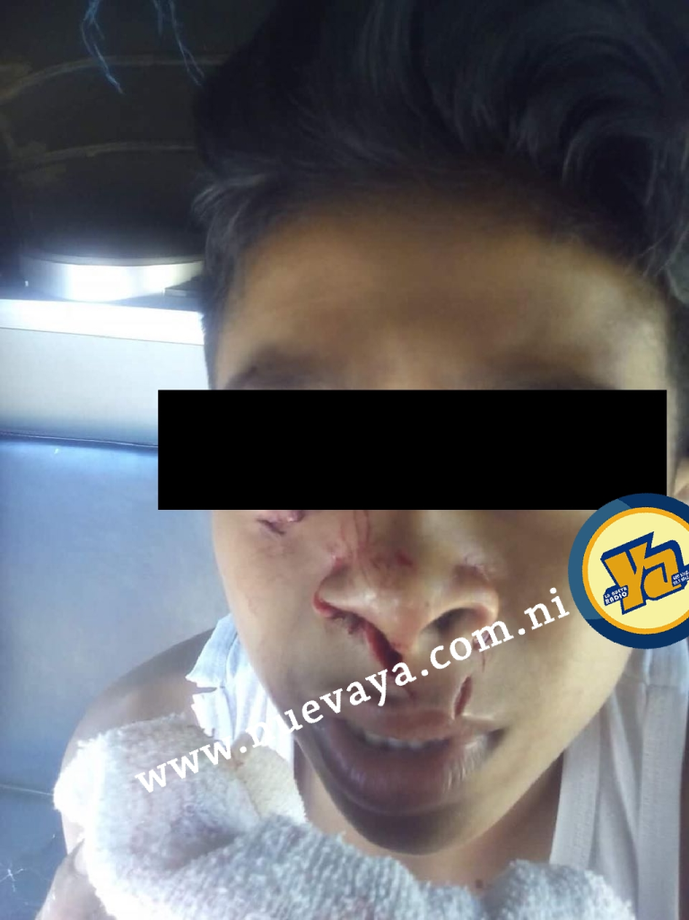 Niño de 13 años es mordido en el rostro por un pitbull en Carazo