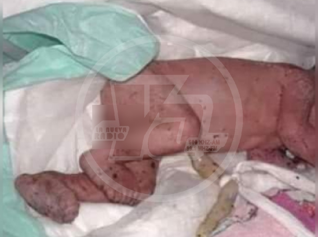 Foto del bebé que fue recuperado del fondo de una letrina pero lamentablemente falleció