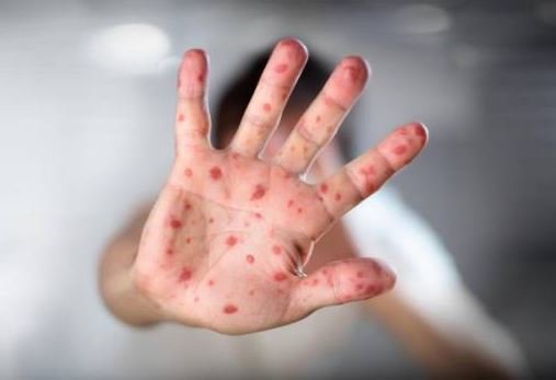 Ministerio de Salud presenta Plan de Acción ante Alerta Internacional de Sarampión