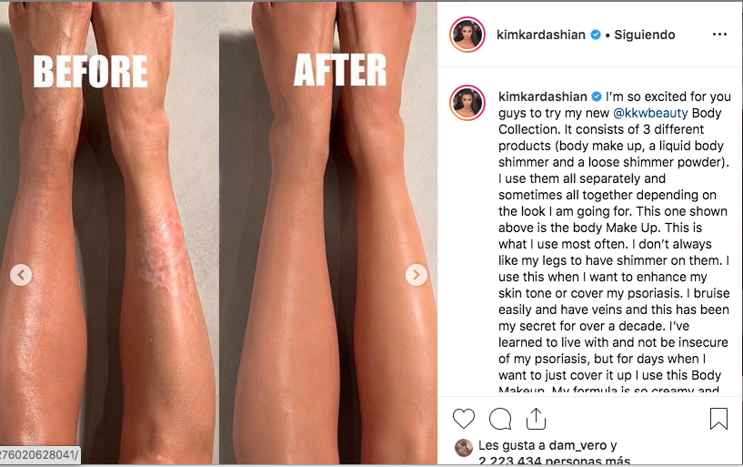 De esta forma Kim Kardashian oculta las marcas de la psoriasis con su maquillaje. Fuente Instagram