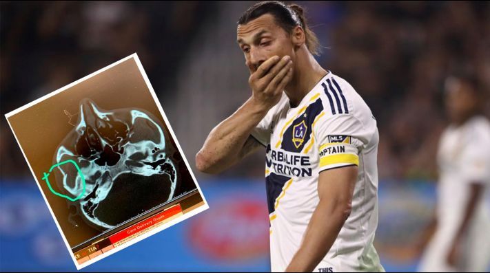 Zlatan Ibrahimovic fractura a rival mientras se jugaba el derby californiano de fútbol