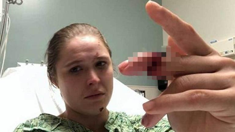 Ronda Rousey sufre la amputación parcial de un dedo