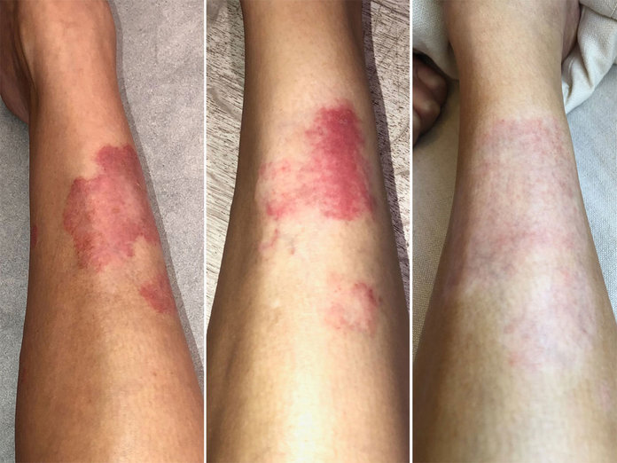 Kim Kardashian padece de psoriasis