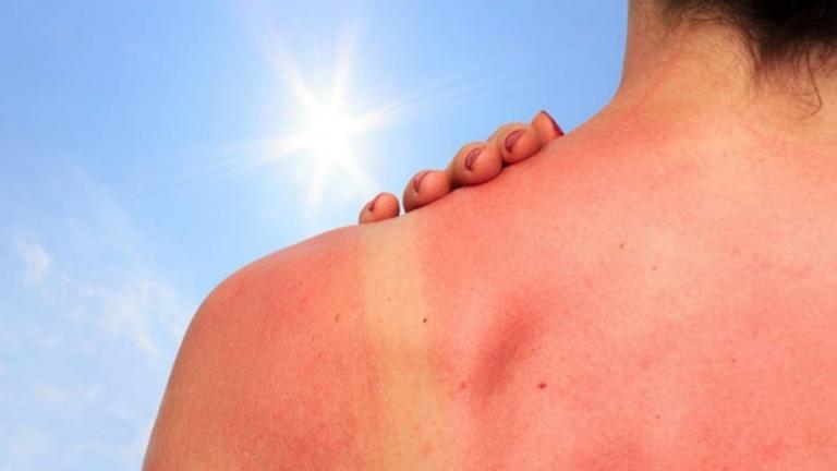 ¿Rojo como un camarón? Aquí te decimos cómo curar tu piel quemada por el sol