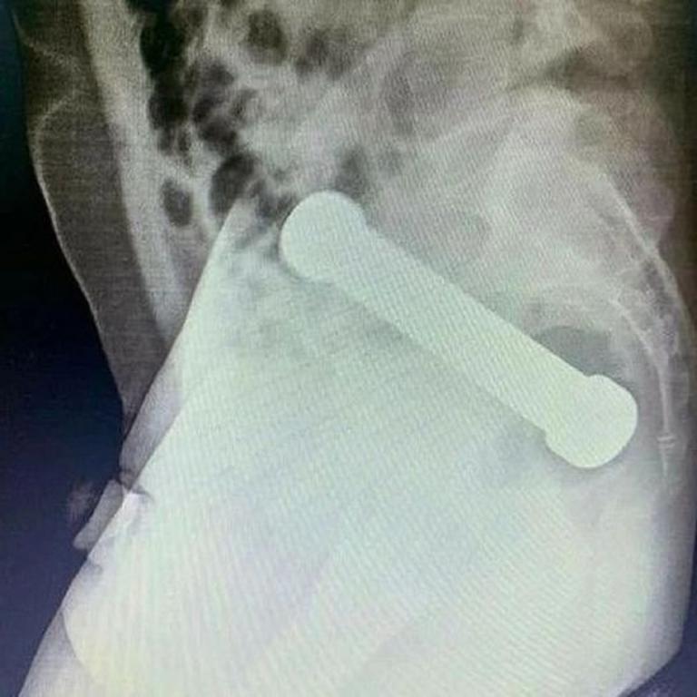 Brasileño busca ayuda médica tras introducirse una mancuerna en su recto