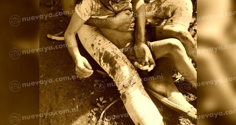 Niña de 5 años resulta seriamente lesionada en el rostro tras ser atacada por un pitbull, en Chinandega