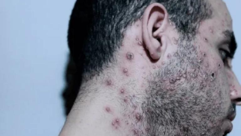 Infectado con viruela del mono huye de hospital de Jalisco y vuela a Estados Unidos