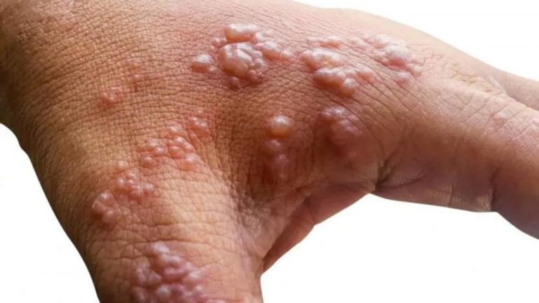Estados Unidos registra primera muerte por viruela del mono