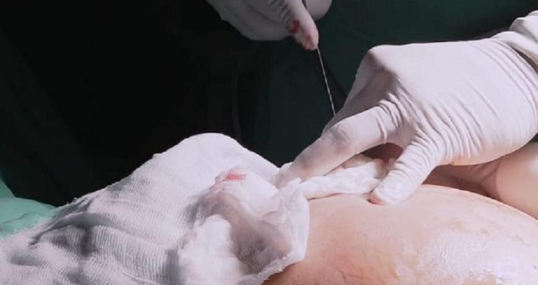 Tercer aniversario de éxito: Nicaragua realiza la cirugía intra -uterina número 203
