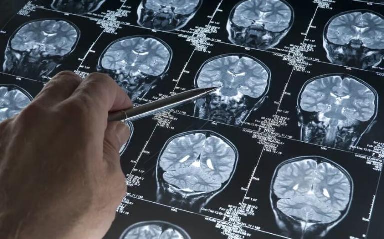 Tratamientos contra el Alzheimer: cuáles son los últimos avances de la ciencia