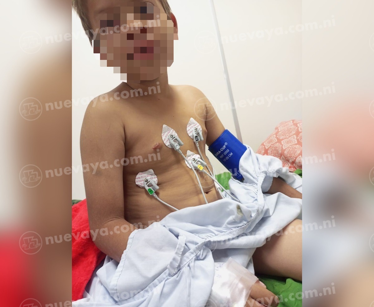 Niño sufre quemaduras por cable de alta tensión en Mateare, Managua