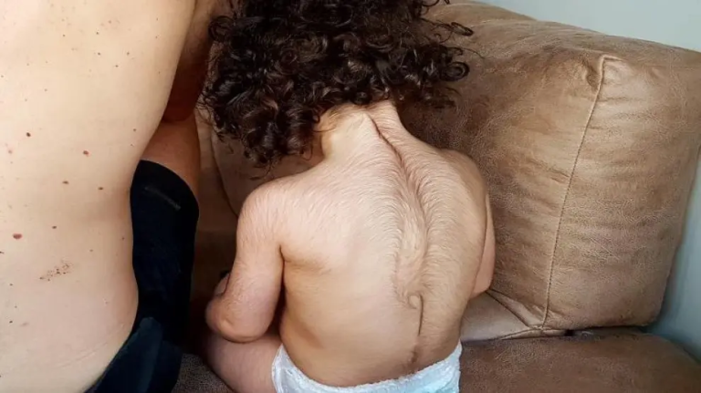 Estudio revela riesgo de aumento de vello en bebés expuestos al minoxidil usado por sus padres