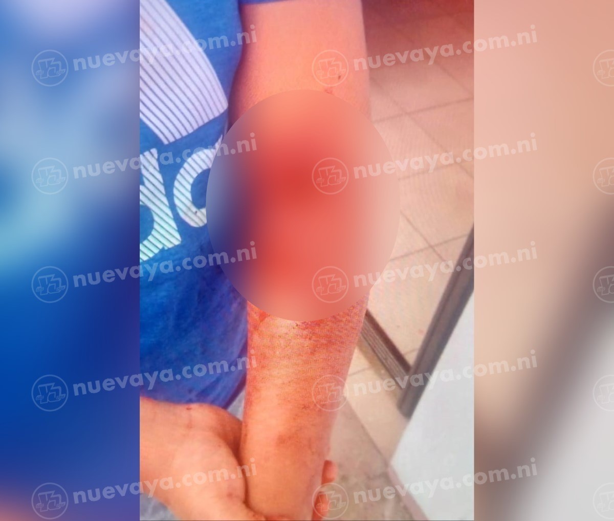 Niño atacado por perro en Estelí: emergencia en Hospital San Juan de Dios