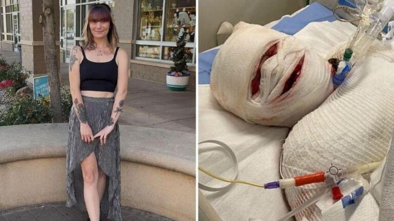 Pierde el 95% de la piel tras grave reacción al ibuprofeno