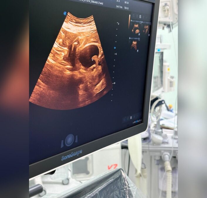 Bertha Calderón: Bebés "salvados" in-utero, ¿milagro o ciencia?