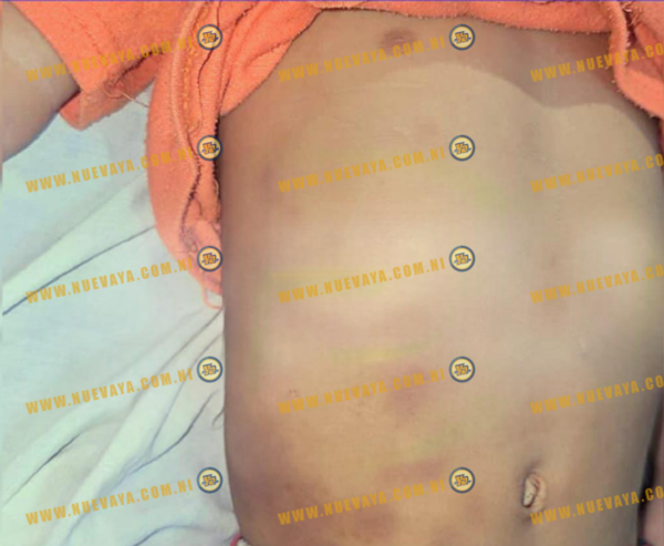 Niño de 3 años muere presuntamente por golpiza de su padrastro en Tipitapa
